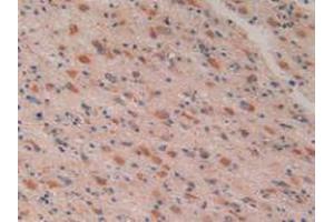 IHC-P analysis of Human Glioma Tissue, with DAB staining. (PTGS2 anticorps  (AA 418-589))
