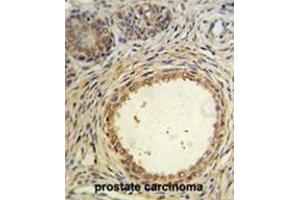 AMH Antibody (Center) IHC analysis in formalin fixed and paraffin embedded prostate carcinoma followed by peroxidase conjugation of the secondary antibody and DAB staining. (AMH anticorps  (Middle Region))