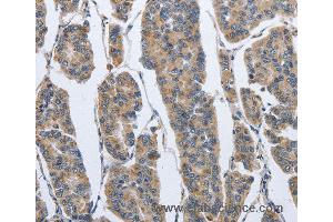 Immunohistochemistry of Human breast cancer using IPO7 Polyclonal Antibody at dilution of 1:40 (IPO7 anticorps)