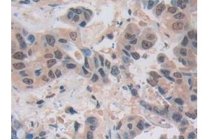 Detection of NUP50 in Human Breast cancer Tissue using Polyclonal Antibody to Nucleoporin 50 kDa (NUP50)