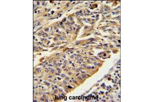 CTSE Antibody IHC analysis in formalin fixed and paraffin embedded human lung carcinoma followed by peroxidase conjugation of the secondary antibody and DAB staining.