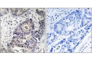 Immunohistochemistry analysis of paraffin-embedded human colon carcinoma, using iNOS (Phospho-Tyr151) Antibody. (NOS2 anticorps  (pTyr151))