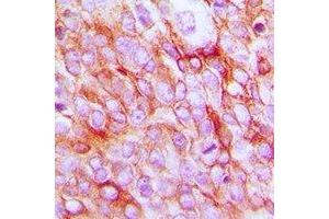 Immunohistochemical analysis of EP2 staining in human prostate cancer formalin fixed paraffin embedded tissue section.