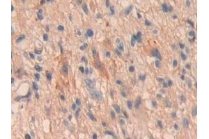 Detection of OIT3 in Human Glioma Tissue using Polyclonal Antibody to Oncoprotein Induced Transcript 3 (OIT3)