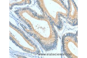 Immunohistochemistry of Human colon cancer using ASGR1 Polyclonal Antibody at dilution of 1:50 (Asialoglycoprotein Receptor 1 anticorps)