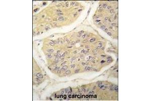 Formalin-fixed and paraffin-embedded human lung carcinoma tissue reacted with B2M antibody (N-term) (ABIN389258 and ABIN2839396) , which was peroxidase-conjugated to the secondary antibody, followed by DAB staining.