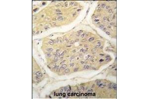 Formalin-fixed and paraffin-embedded human lung carcinoma tissue reacted with B2M antibody (N-term) (ABIN389258 and ABIN2839396) , which was peroxidase-conjugated to the secondary antibody, followed by DAB staining. (beta-2 Microglobulin anticorps  (N-Term))