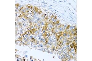 Immunohistochemistry of paraffin-embedded human lung cancer using IFIT3 antibody (ABIN1680389, ABIN3018293, ABIN3018295 and ABIN6220427) at dilution of 1:100 (40x lens).