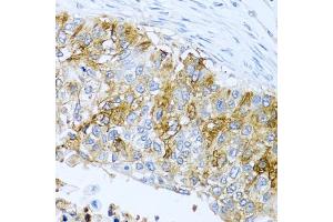 Immunohistochemistry of paraffin-embedded human lung cancer using IFIT3 antibody (ABIN1680389, ABIN3018293, ABIN3018295 and ABIN6220427) at dilution of 1:100 (40x lens). (IFIT3 anticorps  (AA 128-331))