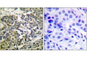 Immunohistochemistry analysis of paraffin-embedded human breast carcinoma, using AMPK alpha (Phospho-Thr172) Antibody. (AMPK alpha anticorps  (pThr183))