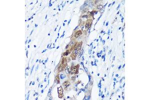 Immunohistochemistry of paraffin-embedded Human lung cancer using C Rabbit pAb (ABIN7266022) at dilution of 1:100 (40x lens). (CAMKK1 anticorps  (AA 399-520))