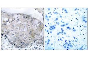 Immunohistochemical analysis of paraffin- embedded human breast carcinoma tissue using V (VEGFR2/CD309 anticorps  (pTyr951))