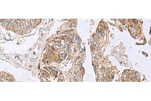 Immunohistochemistry of paraffin-embedded Human colorectal cancer tissue using RTKN2 Polyclonal Antibody at dilution of 1:75(x200) (RTKN2 anticorps)