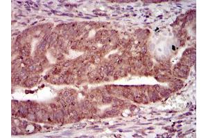 Immunohistochemical analysis of paraffin-embedded rectum cancer tissues using PRKACG mouse mAb with DAB staining.