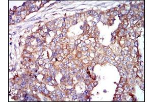 Immunohistochemical analysis of paraffin-embedded breast cancer tissues using G6PD mouse mAb with DAB staining. (Glucose-6-Phosphate Dehydrogenase anticorps)