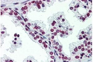 Human Prostate (formalin-fixed, paraffin-embedded) stained with ARID5A antibody ABIN462249 followed by biotinylated goat anti-rabbit IgG secondary antibody ABIN481713, alkaline phosphatase-streptavidin and chromogen.
