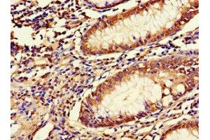 Immunohistochemistry of paraffin-embedded human colon cancer using ABIN7158054 at dilution of 1:100 (LRRIQ3 anticorps  (AA 538-607))