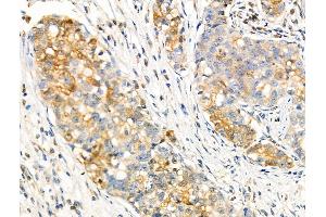 Phospho-FGFR2 (Tyr586/Tyr588) Antibody at 1/100 staining Human gastric cancer by IHC-P. (FGFR2 anticorps  (pTyr586, pTyr588))
