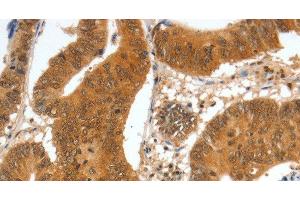 Immunohistochemistry of paraffin-embedded Human colon cancer tissue using SPDEF Polyclonal Antibody at dilution 1:60 (SPDEF/PSE anticorps)