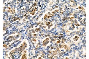 ABIN6265731 and ABIN6266699 at 1/100 staining Human kidney cancer by IHC-P.