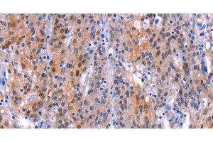 Immunohistochemistry of paraffin-embedded Human gastric cancer tissue using ADM2 Polyclonal Antibody at dilution 1:40