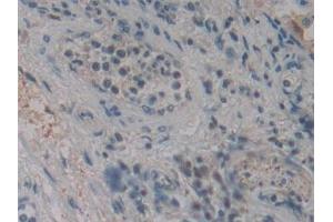 Detection of CYLD in Human Lung cancer Tissue using Polyclonal Antibody to Cylindromatosis (CYLD)