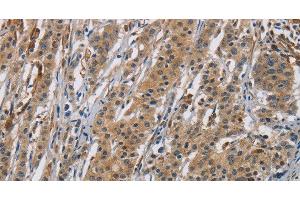 Immunohistochemistry of paraffin-embedded Human gastic cancer using RAGE Polyclonal Antibody at dilution of 1:70 (RAGE anticorps)