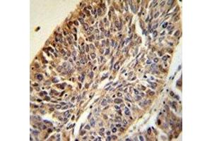 PITX1 antibody IHC analysis in formalin fixed and paraffin embedded human lung carcinoma.