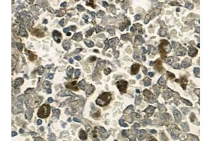 ABIN6257683 and ABIN6274587 at 1/100 staining human melanoma by IHC-P.