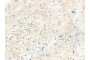 ABIN6256627 and ABIN6267491 at 1/100 staining human astrocytoma by IHC-P. (VEGFR2/CD309 anticorps  (pTyr1214))