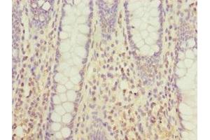 Immunohistochemistry of paraffin-embedded human colon cancer using ABIN7172381 at dilution of 1:100 (DHDH anticorps  (AA 1-334))