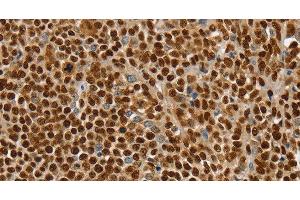 Immunohistochemistry of paraffin-embedded Human ovarian cancer using SSB Polyclonal Antibody at dilution of 1:30 (SSB anticorps)