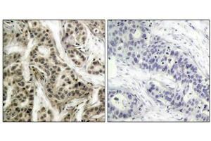 Immunohistochemical analysis of paraffin- embedded human breast carcinoma tissue using NF-kappa,B p105/p50 (phospho-Ser337) antibody.