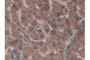 Detection of NPNT in Human Liver cancer Tissue using Polyclonal Antibody to Nephronectin (NPNT)
