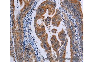 Immunohistochemistry of Human prostate cancer using ACP6 Polyclonal Antibody at dilution of 1:50 (ACP6 anticorps)