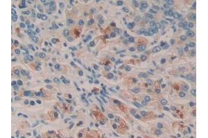 DAB staining on IHC-P; Samples: Human Prostate cancer Tissue
