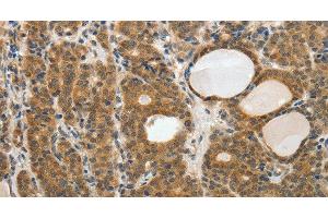 Immunohistochemistry of paraffin-embedded Human thyroid cancer tissue using RARA Polyclonal Antibody at dilution 1:40