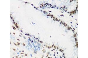 Immunohistochemistry of paraffin-embedded Human stomach cancer using KLF4 Polyclonal Antibody at dilution of 1:200 (40x lens).