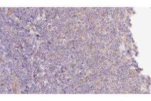 ABIN6273058 at 1/100 staining Human lymph cancer tissue by IHC-P. (MTO1 anticorps  (N-Term))