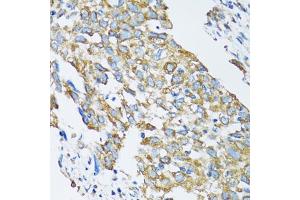 Immunohistochemistry of paraffin-embedded human lung cancer using SLC25A13 antibody. (slc25a13 anticorps)