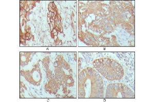 Immunohistochemical analysis of paraffin-embedded human breast carcinoma (A), hepatocarcinoma (B), stomach cancer (C) and colon cancer tissue (D), showing cytoplasmic location with DAB staining using CK18 mouse mAb. (Cytokeratin 18 anticorps  (AA 391-483))