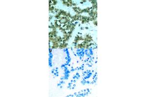Immunohistochemical staining of human lung cancer tissue by PRKCQ (phospho S676) polyclonal antibody  without blocking peptide (A) or preincubated with blocking peptide (B) under 1:50-1:100 dilution. (PKC theta anticorps  (pSer676))