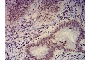 Immunohistochemical analysis of paraffin-embedded rectum cancer tissues using EHMT2 mouse mAb with DAB staining. (EHMT2 anticorps  (AA 317-471))