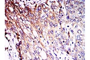 Immunohistochemical analysis of paraffin-embedded lung cancer tissues using NEFL mouse mAb with DAB staining. (NEFL anticorps)