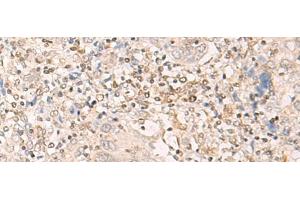 Immunohistochemistry of paraffin-embedded Human cervical cancer tissue using EPSTI1 Polyclonal Antibody at dilution of 1:25(x200) (EPSTI1 anticorps)