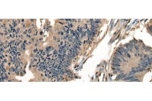 Immunohistochemistry of paraffin-embedded Human colorectal cancer tissue using DNAJC2 Polyclonal Antibody at dilution of 1:40(x200)