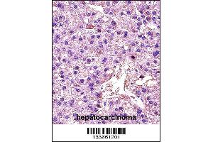 LDHA Antibody immunohistochemistry analysis in formalin fixed and paraffin embedded human hepatocarcinoma followed by peroxidase conjugation of the secondary antibody and DAB staining.