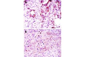 Immunohistochemical analysis of paraffin-embedded human mammary cancer tissue (A) and lung cancer tissue (B) using TNFRSF11B monoclonal antobody, clone 5A11  with DAB staining.