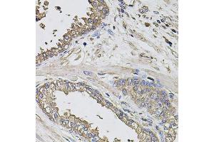 Immunohistochemistry of paraffin-embedded human prostate using GRN antibody (ABIN6292502) at dilution of 1:100 (40x lens). (Granulin anticorps)