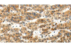 Immunohistochemistry of paraffin-embedded Human ovarian cancer tissue using PAPPA Polyclonal Antibody at dilution of 1:50 (PAPPA anticorps)